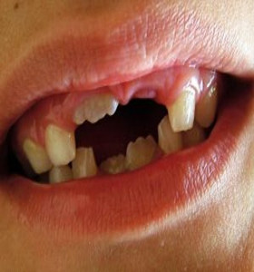 西安儿童牙齿缺失需要补牙吗